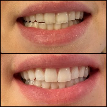 blanchiment_des_dents_geneve