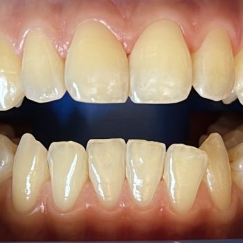 blanchiment_des_dents_geneve_centre