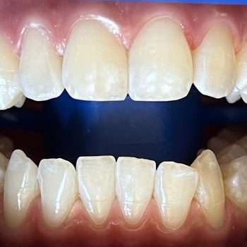 blanchiment_des_dents_geneve_centre_apres