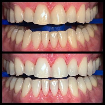 blanchiment_des_dents_geneve_lausanne