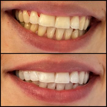 teeth whitening geneva before after