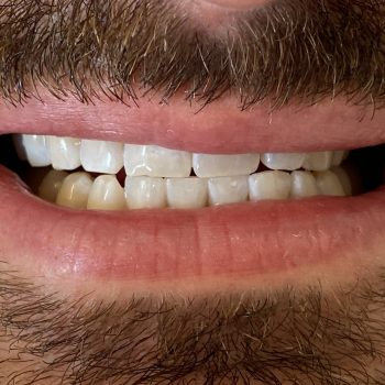 blanchiment_des_dents_lausanne_apres