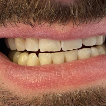 blanchiment_des_dents_lausanne_avant