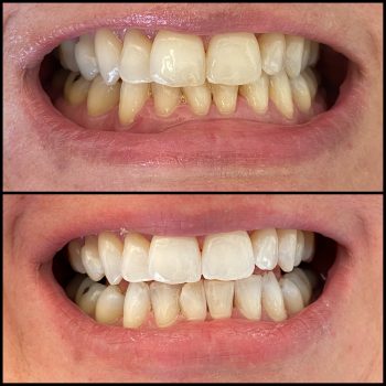invisalign_lausanne