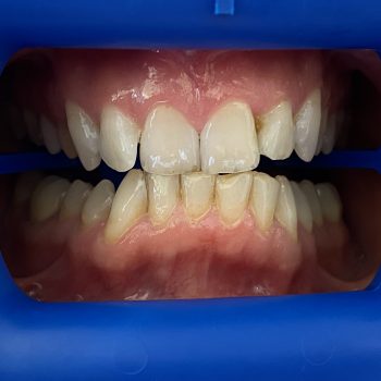 teeth_whitening_geneva_1