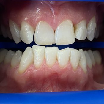 teeth_whitening_geneva_2