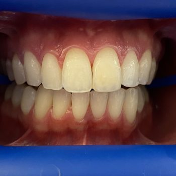 teeth_whitening_lausanne_1