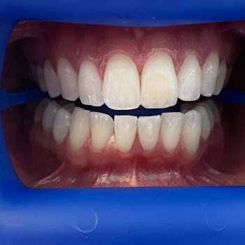 teeth_whitening_lausanne_2