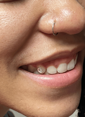 bijoux dentaire Lausanne