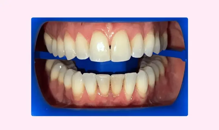 blachiment dentaire lausanne genève procedure ecarteur dentaire