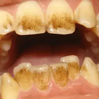 brown teeth