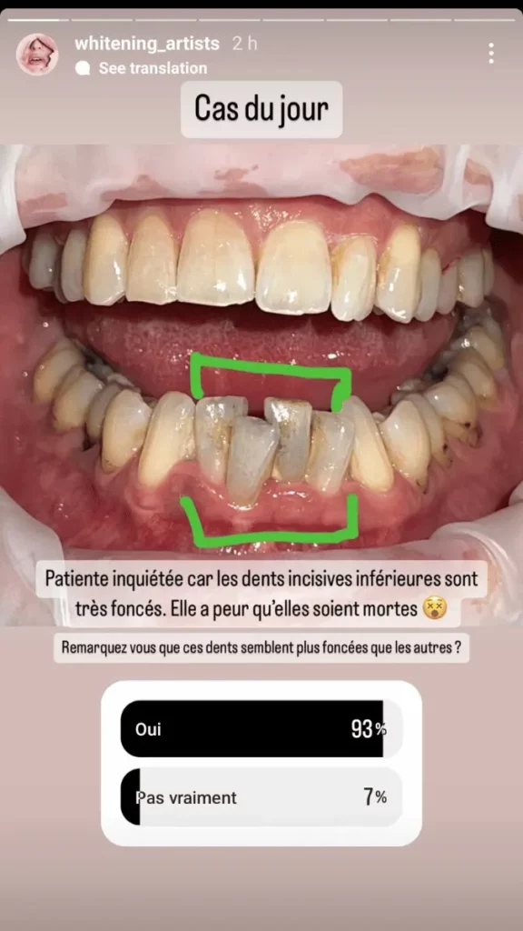 Peur d'avoir des dents morts Cas du jour