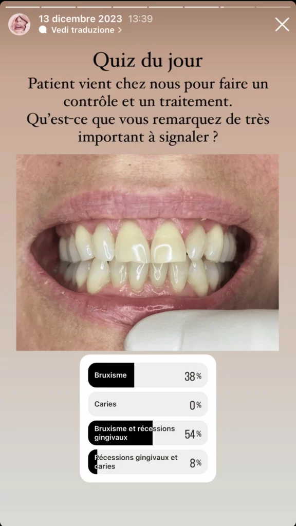 Patiente avec Bruxisme et Recession Gingival Incisive