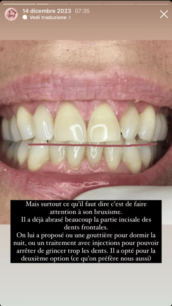 Solution pour patiente avec Bruxism