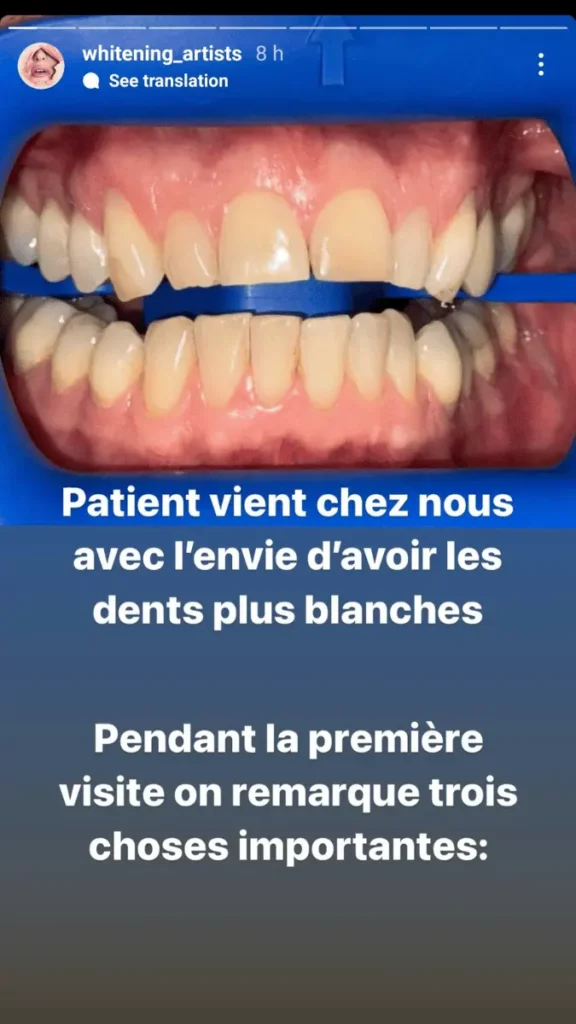 Patiente avec composites envie dents blanches