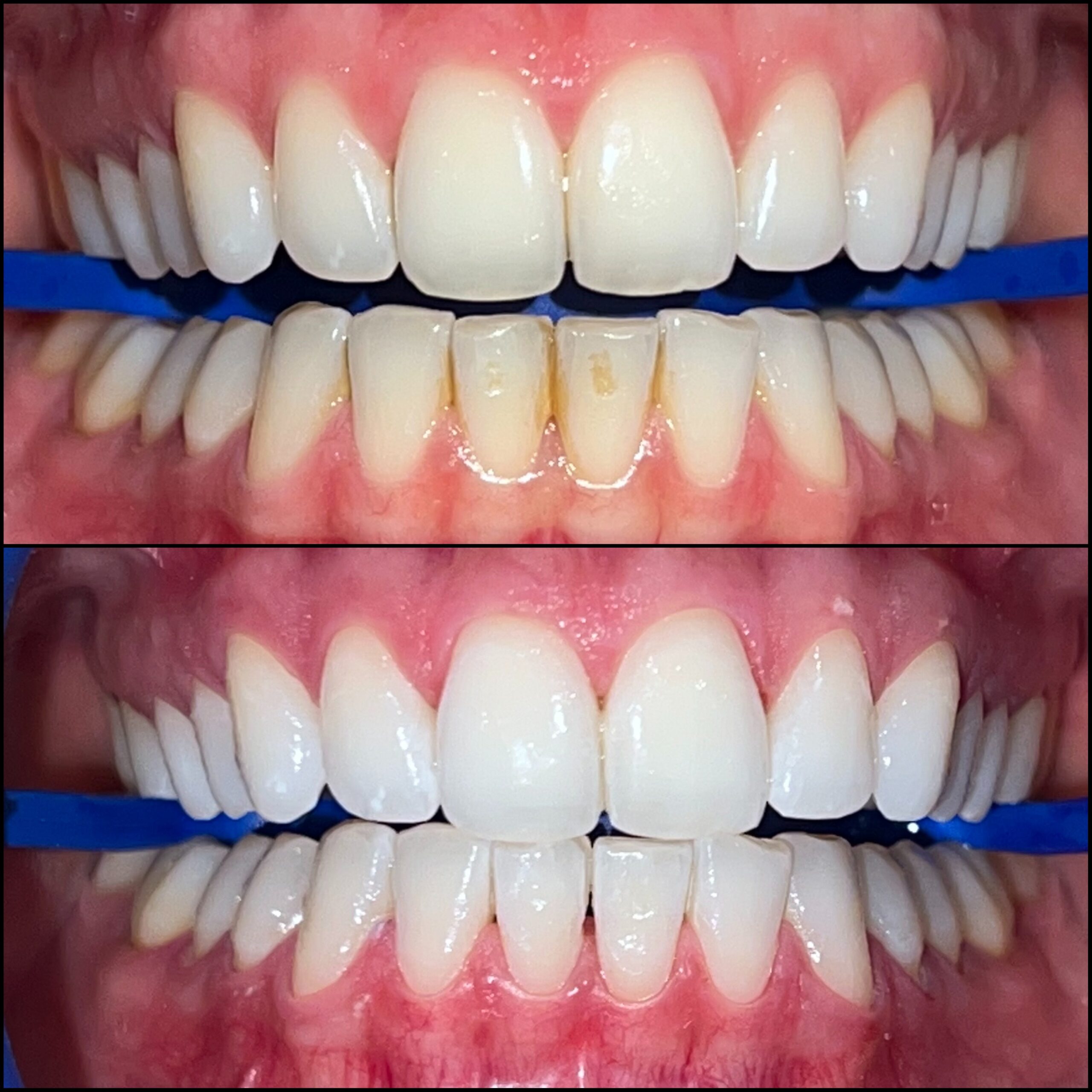 Avant après blanchiment dentaire chez Whitening Artists à Genève et Lausanne