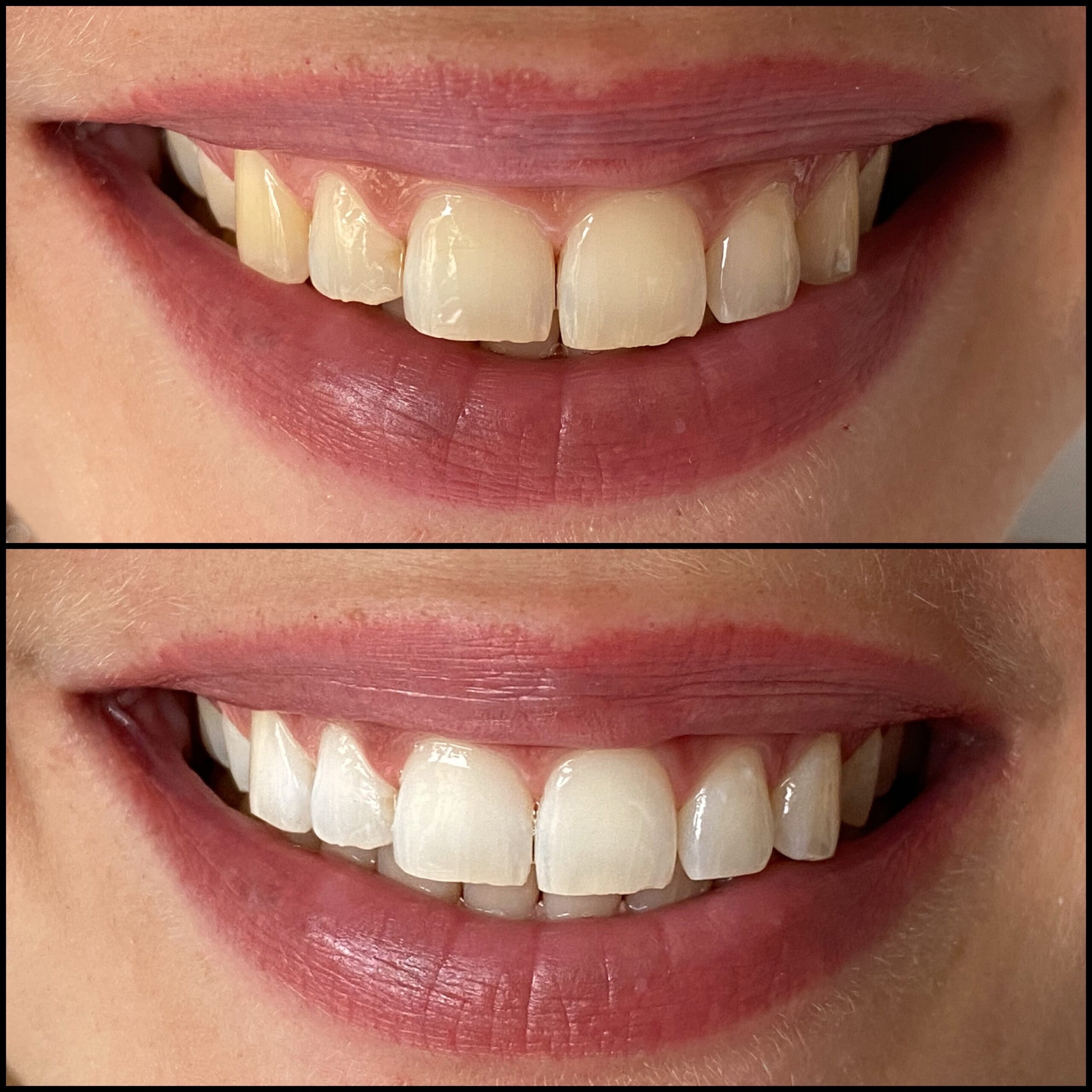 Avant et après un blanchiment dentaire professionnel chez Whitening Artists à Genève et Lausanne