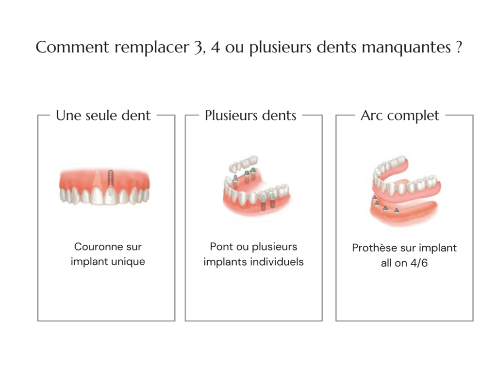Examples of options for replacing several missing teeth
