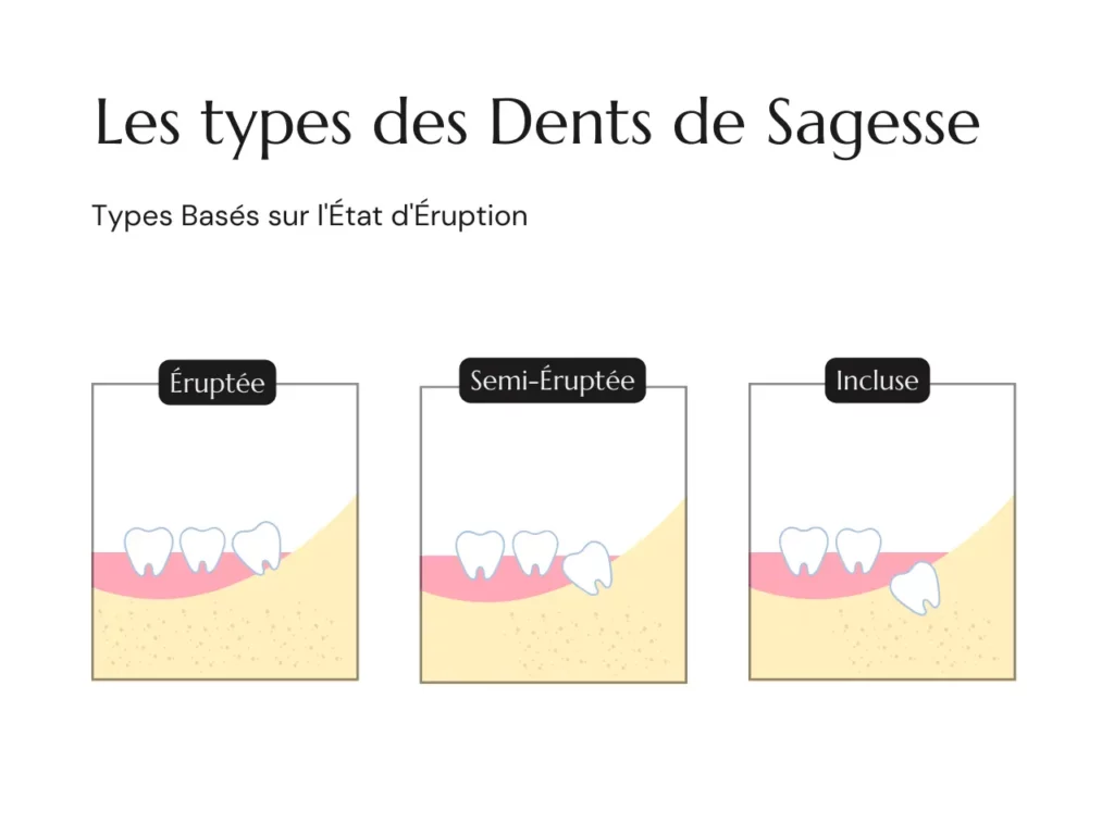 Dents éruptées, semi-éruptées et incluses : le bilan détermine la conduite à tenir.