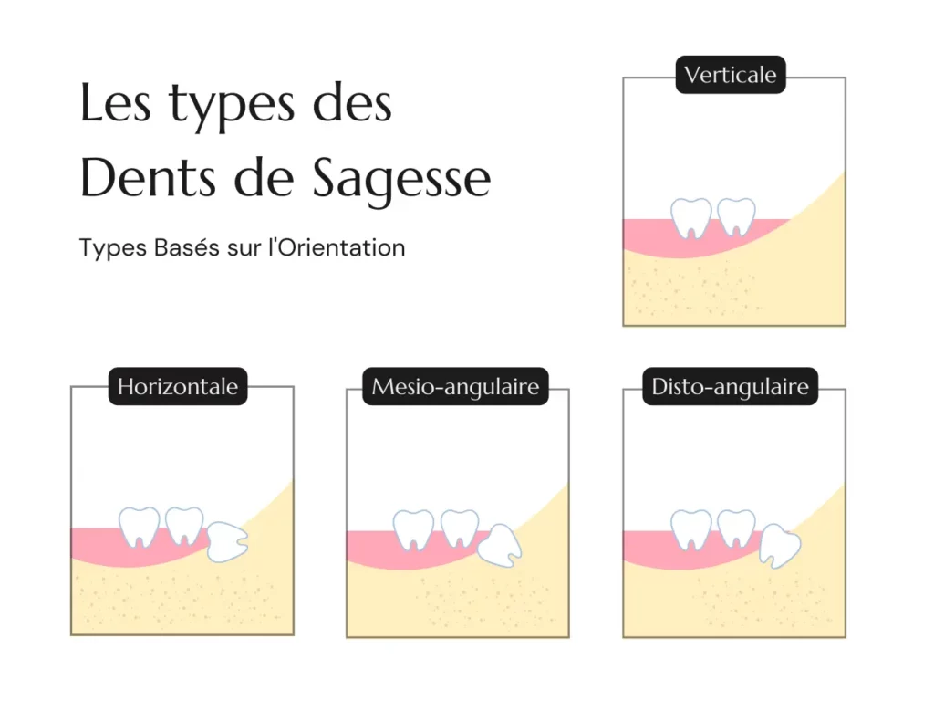 L’orientation des dents de sagesse aide à planifier les soins.
