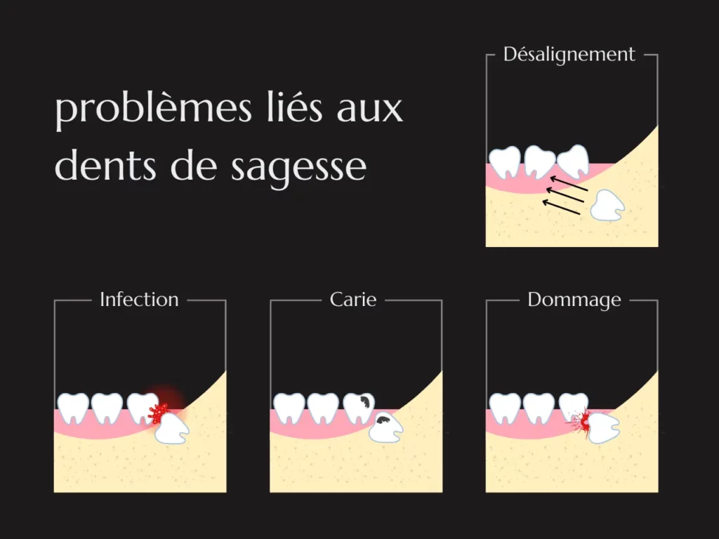 Des complications possibles, sans extraction systématique. Un déplacement des dents ne peut pas être attribué à la seule présence des dents de sagesse.